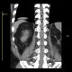Air bubbles in spinal canal after stentgraft placement and spinal anesthesia, spinal paraparesis: CT - Computed tomography